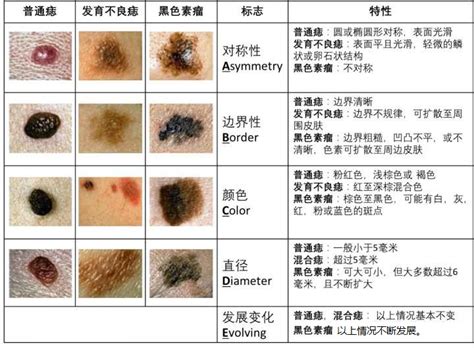 先天性色素痣|先天性黑色素细胞痣的激光疗法:系统性评述 